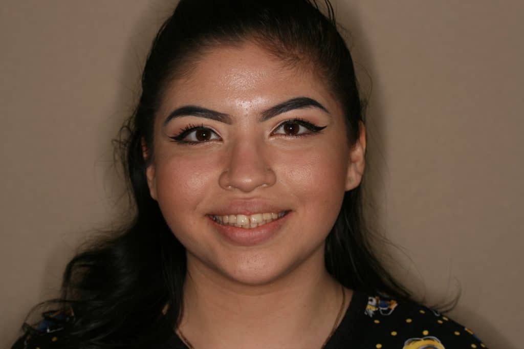 Woman smiling showing her teeth before Invisalign treatment