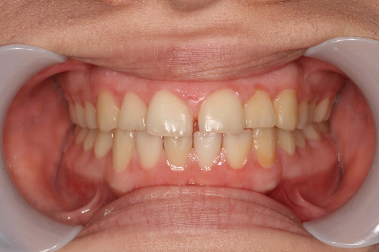 Dental patient before Invisalign treatment