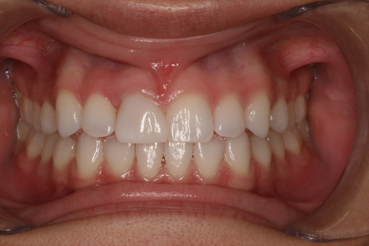 Dental patient after Invisalign treatment in Oakdale, CA