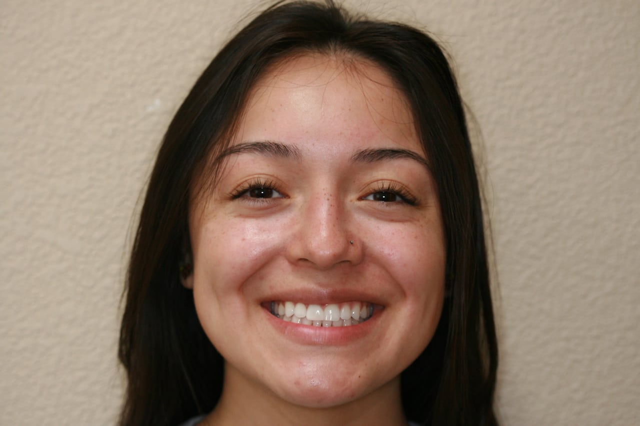 Woman smiling showing her teeth after Invisalign treatment