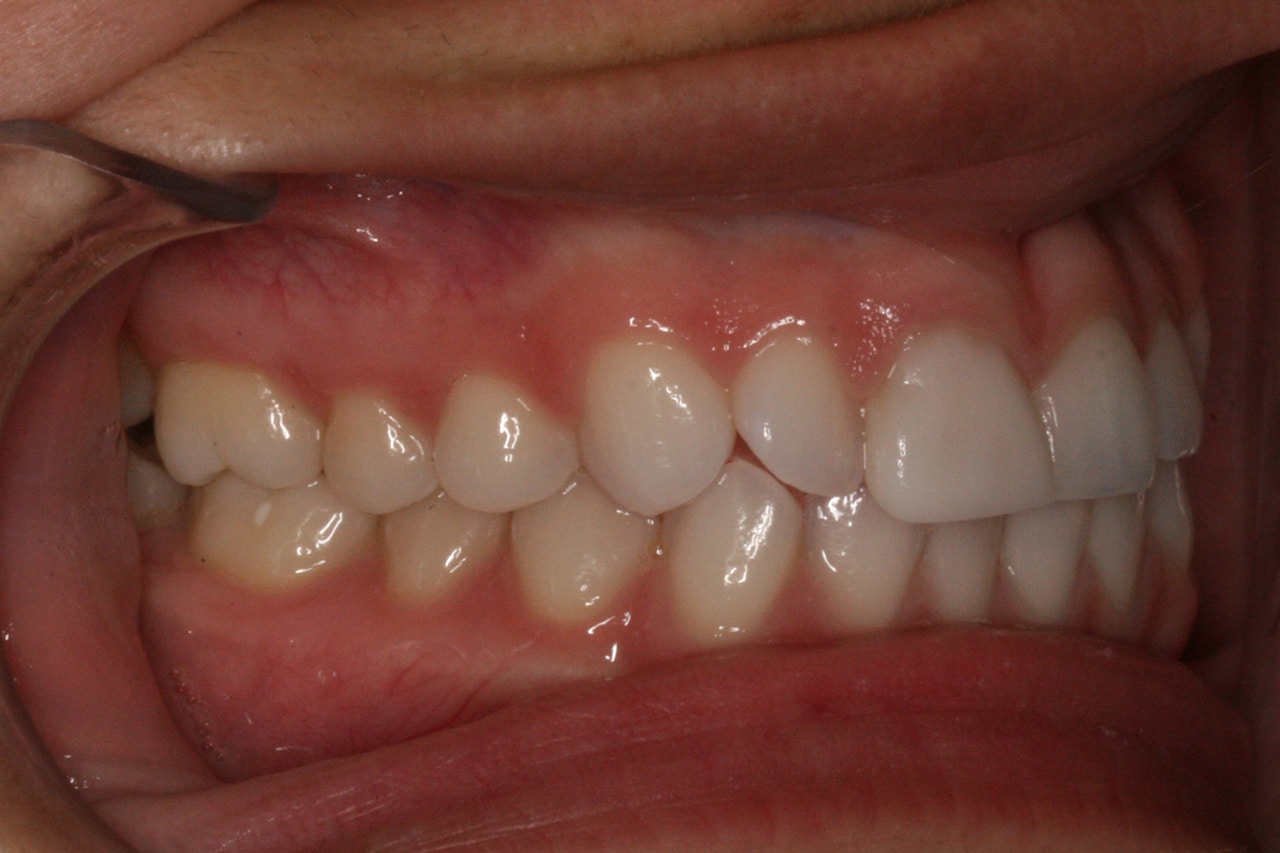Imperfect teeth alignment before Invisalign treatment
