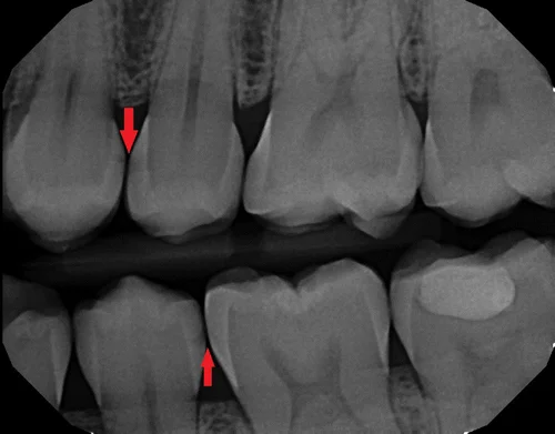 Dental X Ray showing tooth decay caused by a lack of oral hygiene