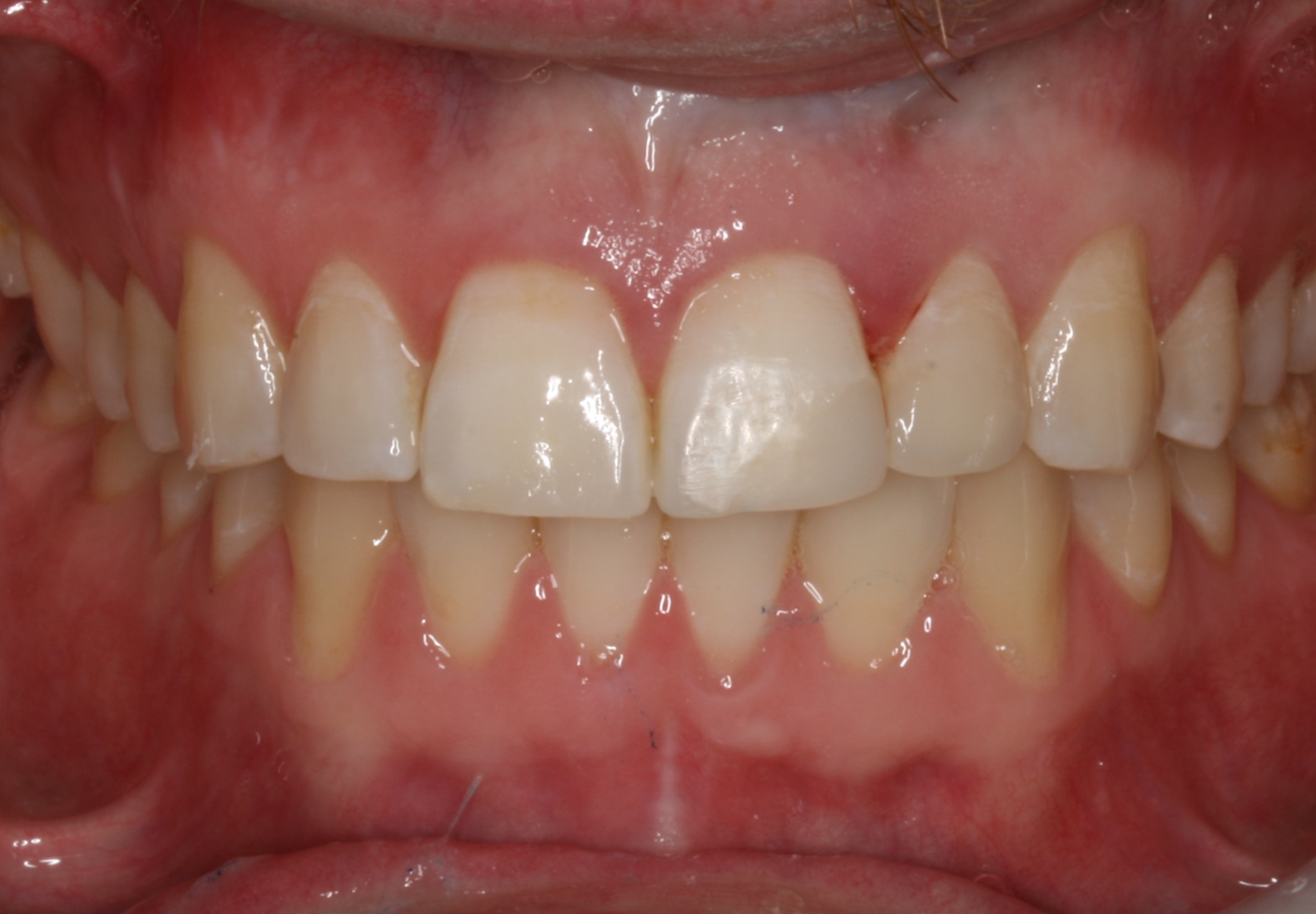 Teeth after applying dental bonding in Oakdale, CA