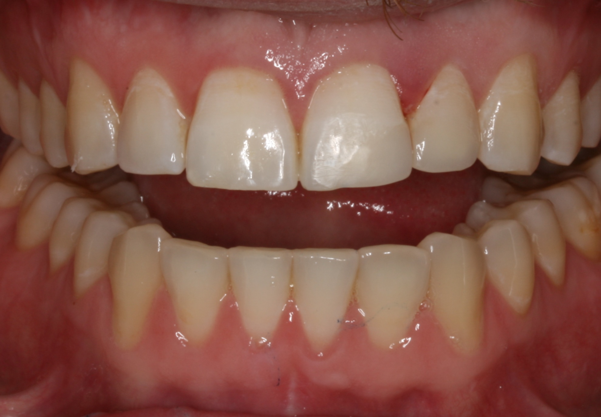 Teeth after applying dental bonding in Oakdale, CA