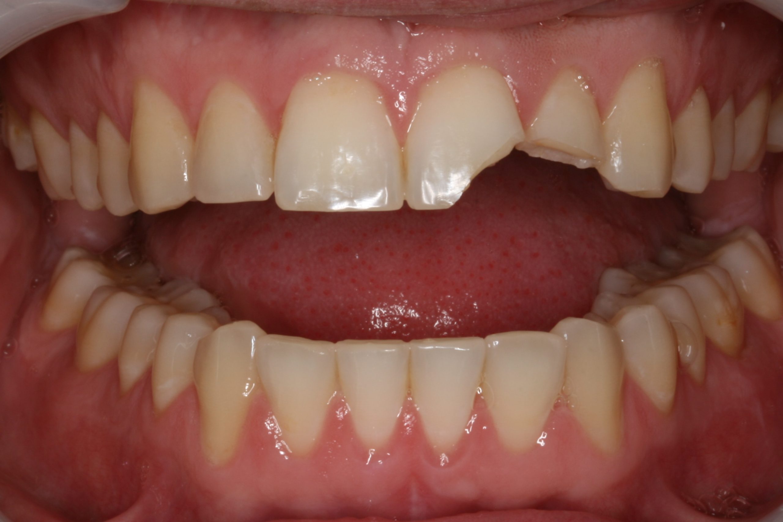 Broken teeth before applying dental bonding in Oakdale, CA