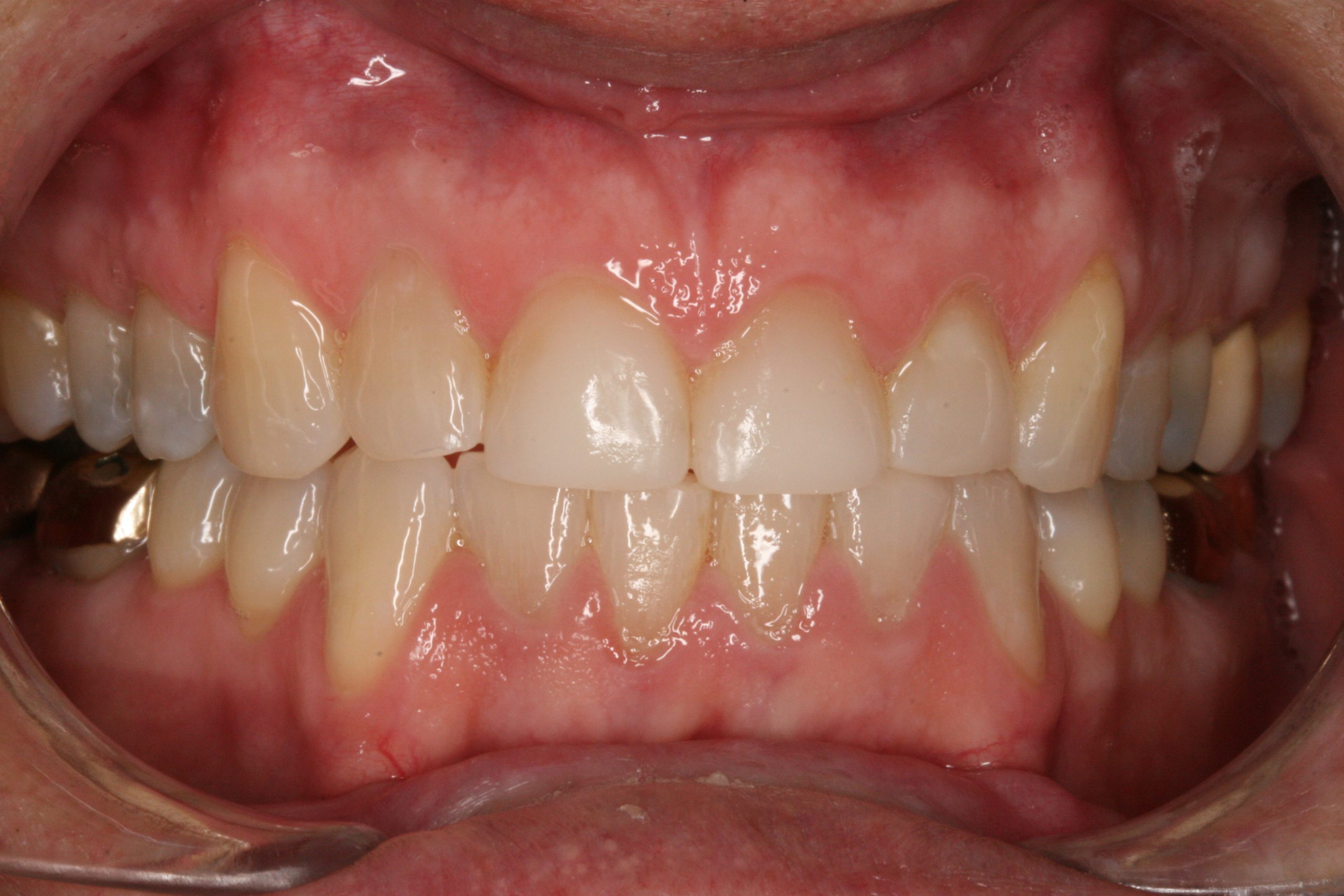 Teeth after using Invisalign and dental bonding in Oakdale, CA